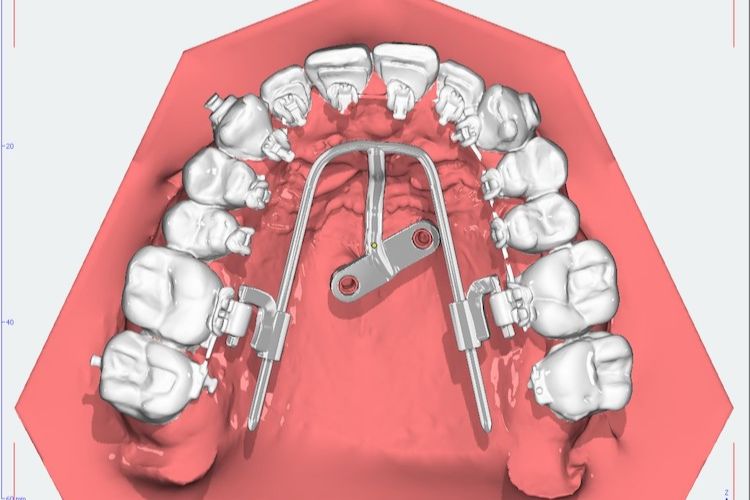 3 D Planung festsitzender Behandlungsgeräte