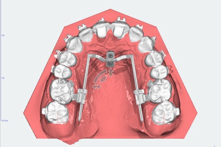 3 D Planung festsitzender Behandlungsgeräte